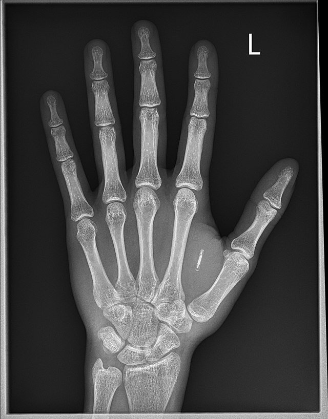 A left hand x-ray photo